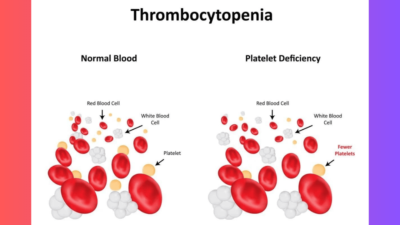 Thrombocytopenia: 4 Main Causes, Symptoms, And Treatment Easily